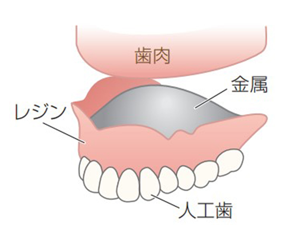 金属床入れ歯イメージ