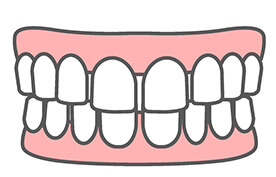 空隙歯列（すきっ歯）