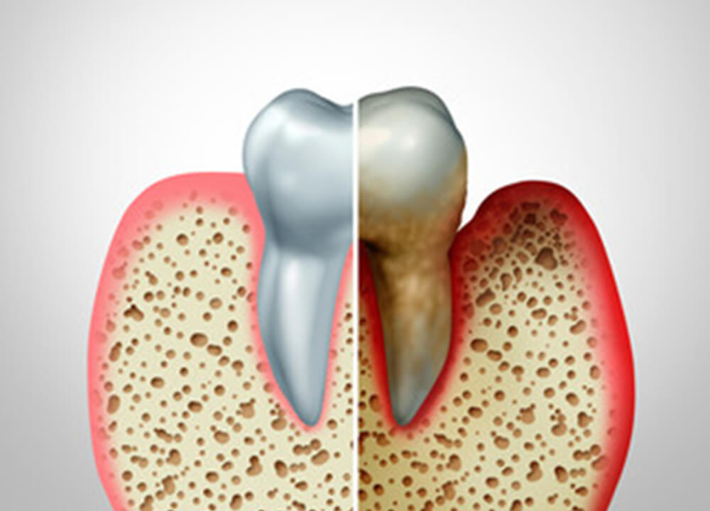 歯周病イメージ