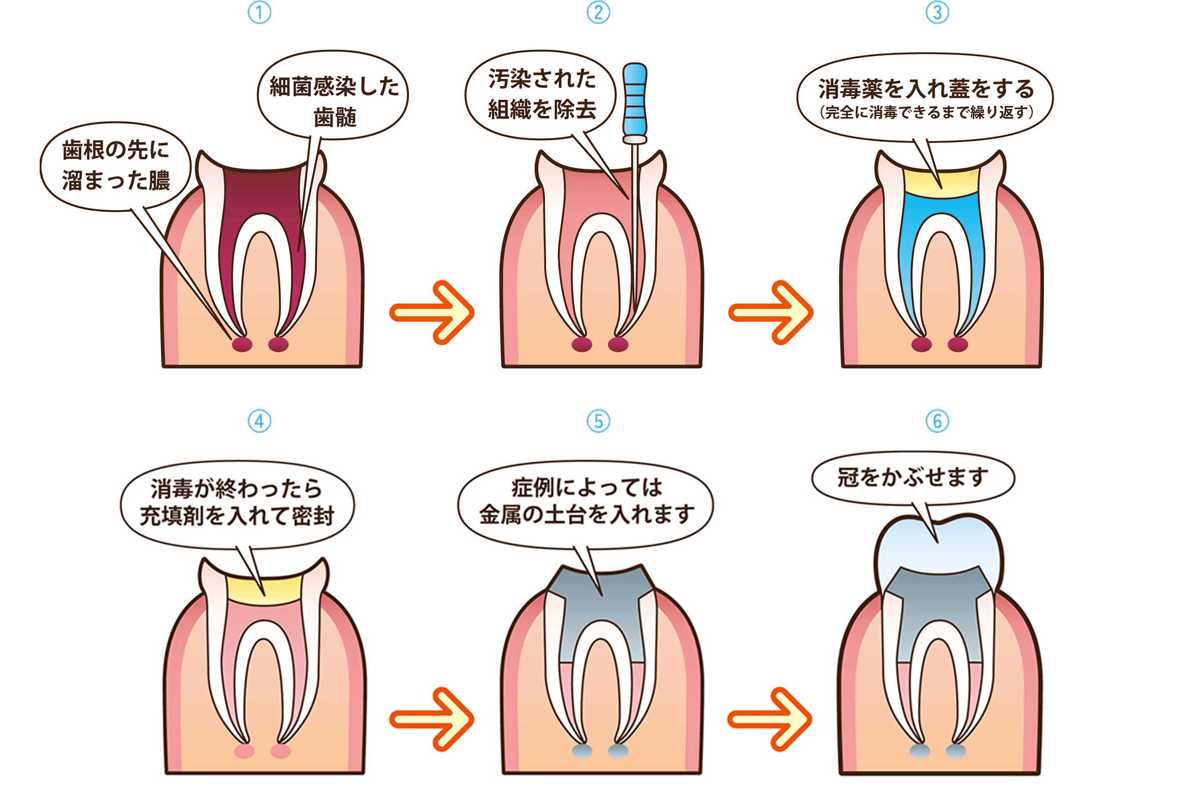 根管治療イメージ