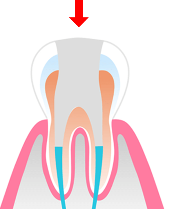 根管治療イメージ
