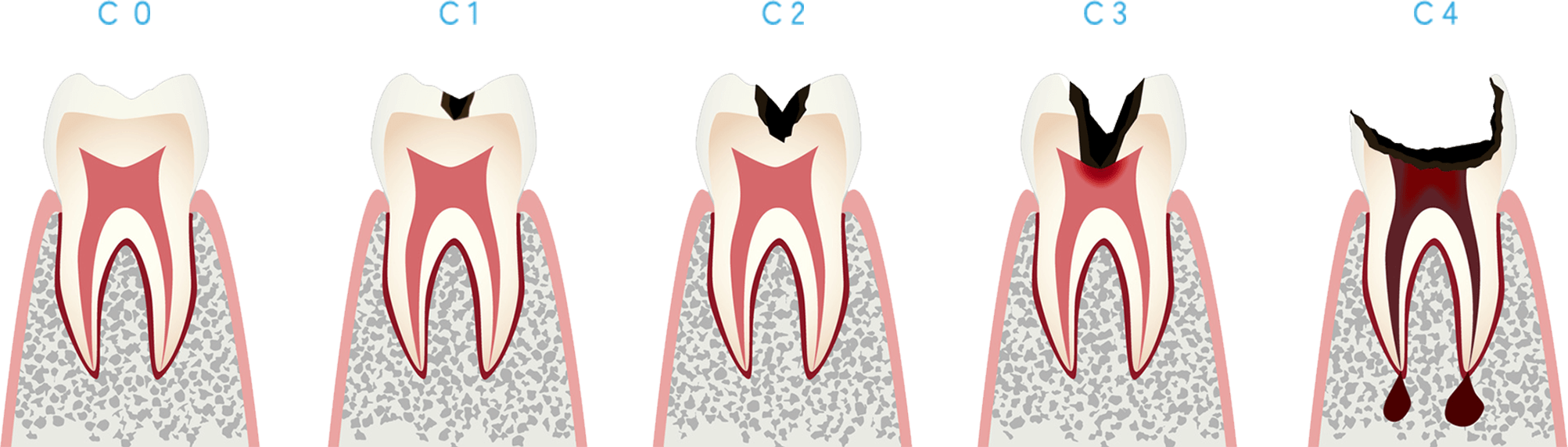 むし歯のステージと進行状態イメージ